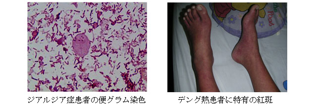 ジアルジア症患者の便グラム染色 デング熱患者に特有の紅斑