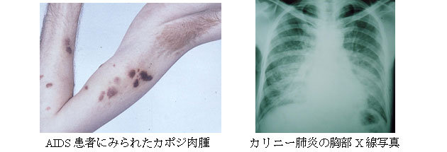 AIDS患者にみられたカポジ肉腫カリニー肺炎の胸部X線写真