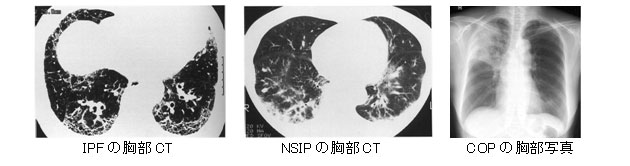 4.特発性間質性肺炎