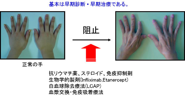 基本は早期診断  早期治療である