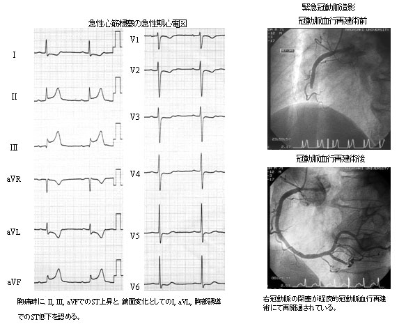 A.虚血性心疾患(狭心症、心筋梗塞など)