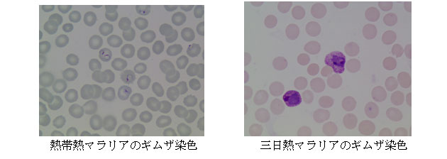 熱帯熱マラリアのギムザ染色三日熱　マラリアのギムザ染色