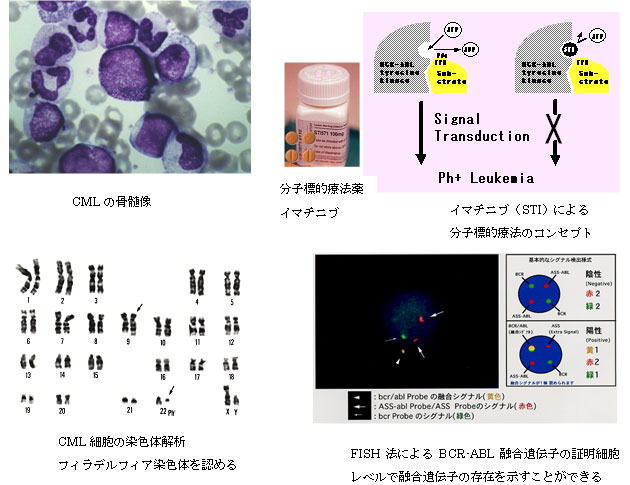 A.慢性骨髄性白血病