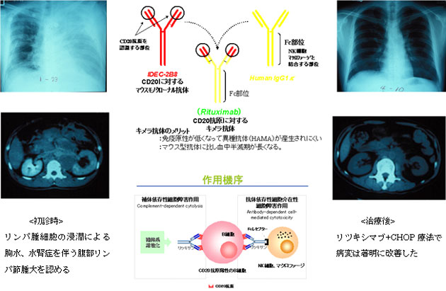 B.CD20陽性B細胞性リンパ腫