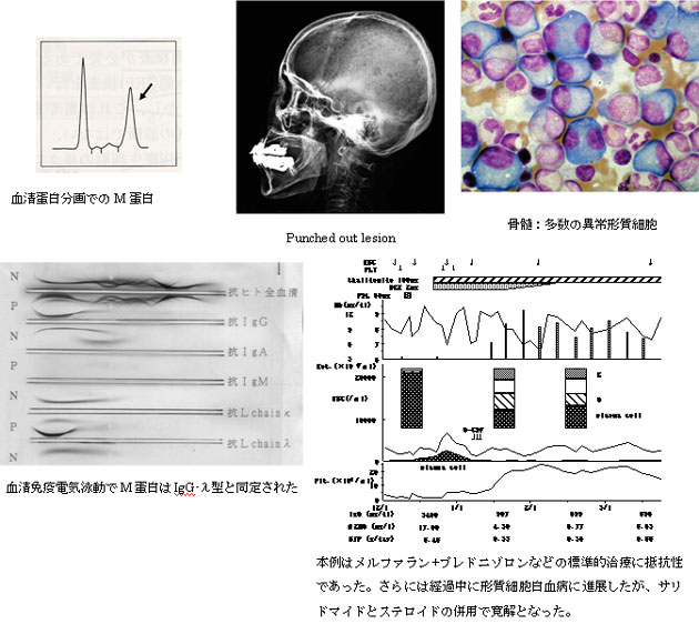 C.多発性骨髄腫