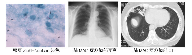 2.肺結核・非結核性抗酸菌症