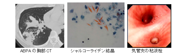 3.アレルギー性気管支肺アスペルギルス症(ABPA)