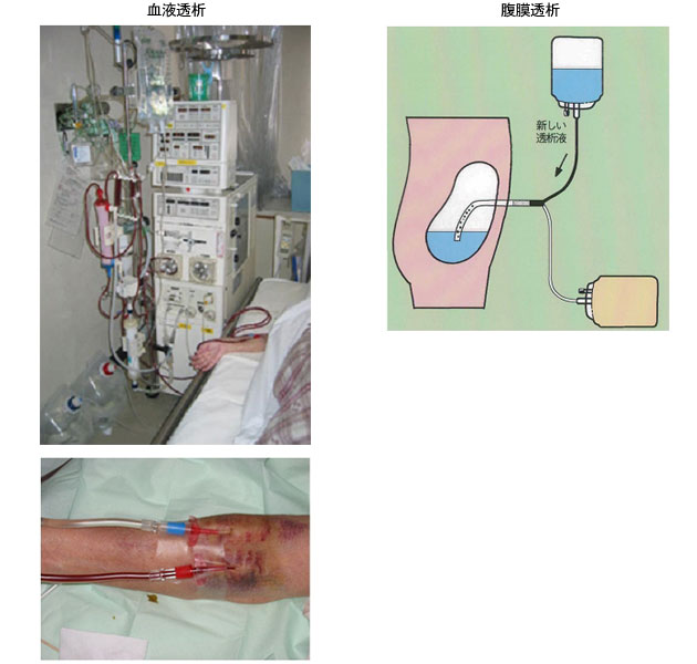 5.慢性腎不全