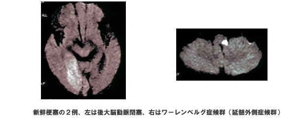 脳血管障害