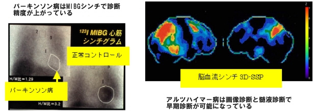 神経変性疾患など