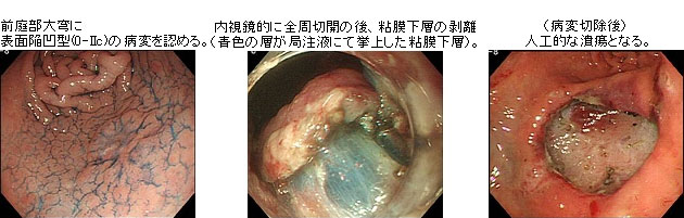 胃がんの説明