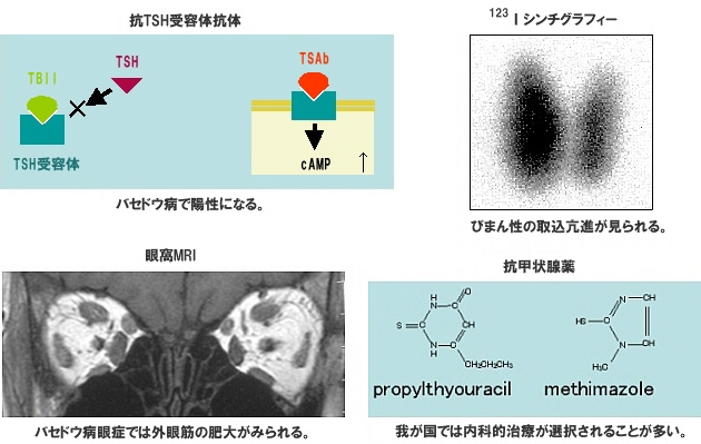 バセドウ病
