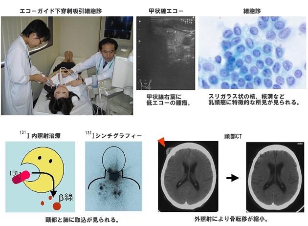 甲状腺癌